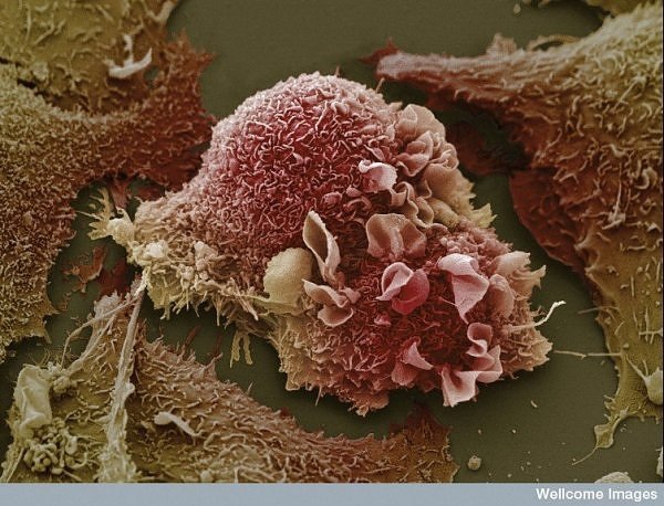 [lung cancer cells[3].jpg]