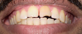 My Teeth after the Dentist Cleaned them. My Teeth after the dentist removed the plaque