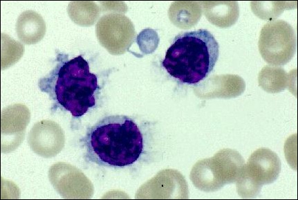 tricoleucemia (células cabeludas) tricoleucemia (células cabeludas)