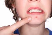 [pimple[3].jpg]