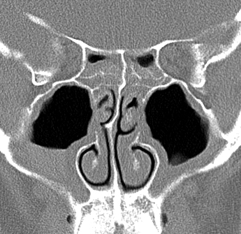 pansinusitis