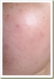 Glowing Skin after eCO2 Fractional laser