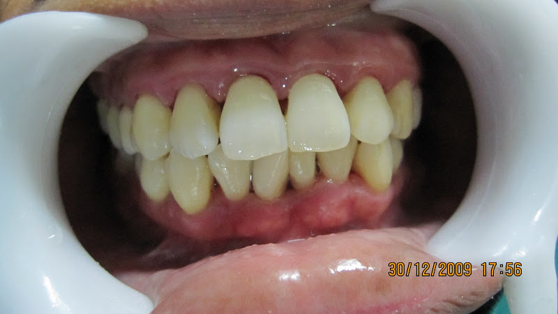 after remove dental calculus