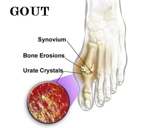 Gout