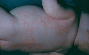 miliaria rubra