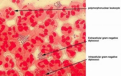 Gonorrhea