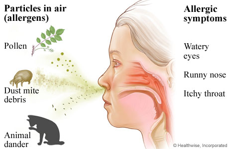 allergic rhinitis