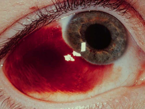 subconjunctival hemorrhage