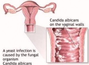 vaginal candidiasis