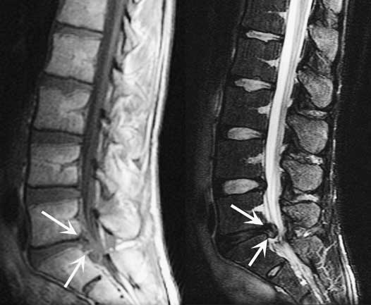 lumbar disc herniation