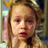 Erythema Multiforme 2008