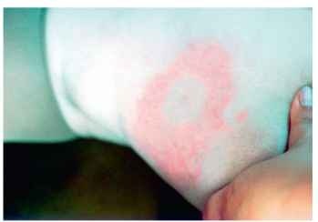 Erythema migrans, the skin lesion that is often present during early-stage Lyme disease. It typically occurs at the site of attachment of an infective tick, but multiple=