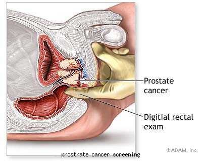 [prostrate cancer screening[3].jpg]