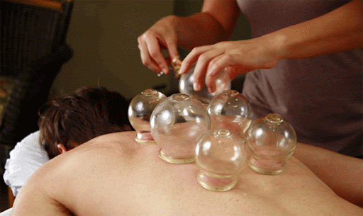 Chinese Cupping treatment