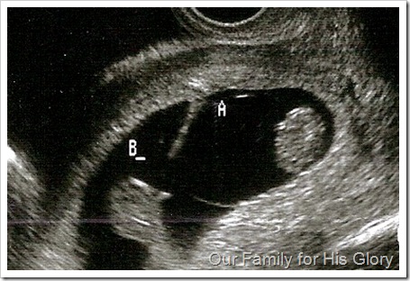 twins ultrasound