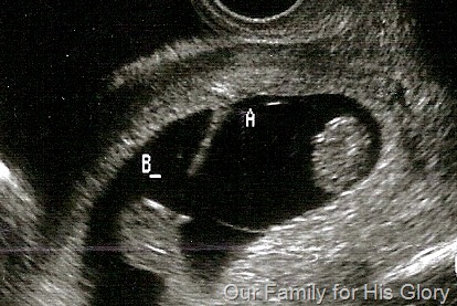 [twins ultrasound[8].jpg]