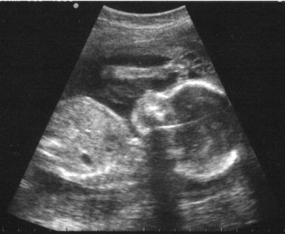 [ultrasound[3].jpg]