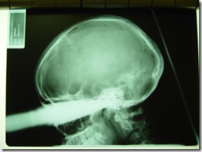 KnifeInHead_TraumaSocietyOfSouthAfrica_TraumaLog