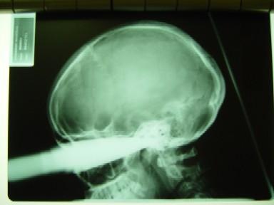 [KnifeInHead_TraumaSocietyOfSouthAfrica_TraumaLog.jpg]