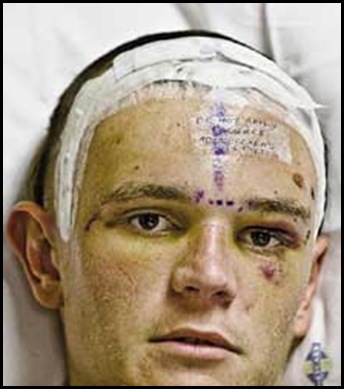 Beaten Up Child