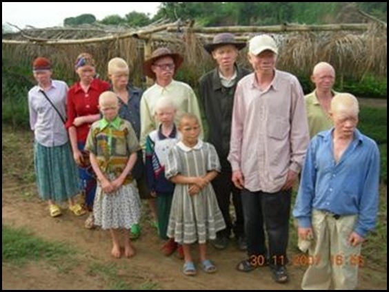 Albinos_HelpBurundi