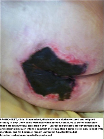 [BRONKHORST Chris untreated bedsores buttocks hospice[5].jpg]