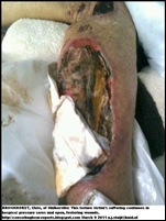 Bronkhorst Chris maltreatment hospice attack victim dies April242011