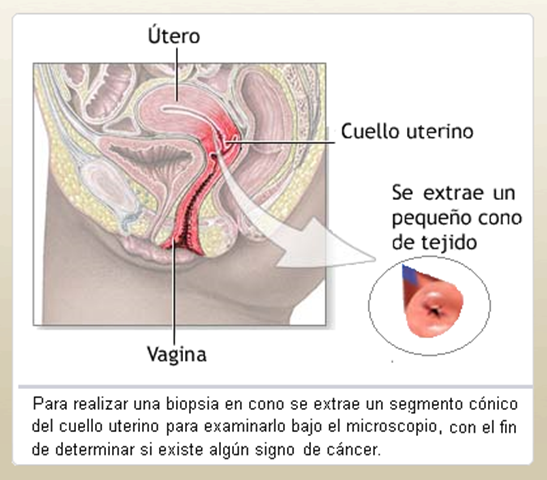 [Extirpación de segmento cónico 2.png]