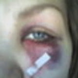 A black eye
