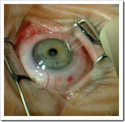 What Is Lasik