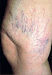 Varices No Escondas Mas Tus Piernas