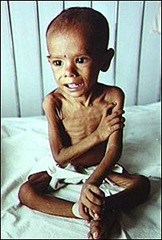 Niño desnutrido. Niño desnutrido.