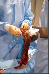 Marc Dorce arm in surgery