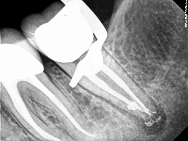 [Endodontic Complexity check filmb[3].jpg]