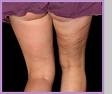Celulitis preocupaci&oacute;n permanente de las mujeres