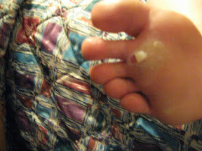 I had blisters from Chicago
