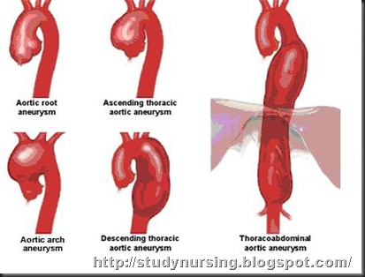 how fast can a thoracic aortic aneurysm grow