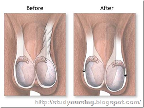 Visual Signs Of Testicular Torsion