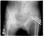 Afghan pt w/ 3 month old injury. Had attempt at femoral neck fixation. Now has sacral nonunion and failed femoral neck fixation. Pt ambulated w/ crutches and is able to lace his shoes. He has posterior hip pain but the main complaint is difficulty voiding. Retrograde urethrogram shows urethral stricture.