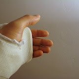 The metacarpals below my two middle fingers are rotated