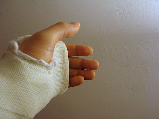 The metacarpals below my two middle fingers are rotated