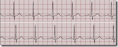 EKG Chart