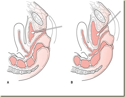 Cotton Bud Test Cotton Bud Test