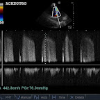CW Doppler trace of Aortic Regurgitation