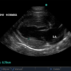 HCM in an 18mo DSH