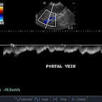 PW Doppler trace of Portal Vein 6 weeks post-ligation – Same Dog (normal flow rate)