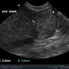 Right Adrenal mass in a 14yo crossbreed with HAC