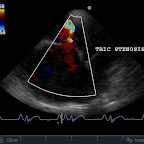 Tricuspid stenotic jet into Right Ventricle, same dog