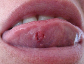 BITING TONGUE
