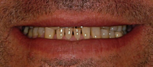 teeth1